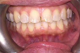 Gramercy Smiles | Preventative Program, ZOOM  Whitening and Invisalign reg 