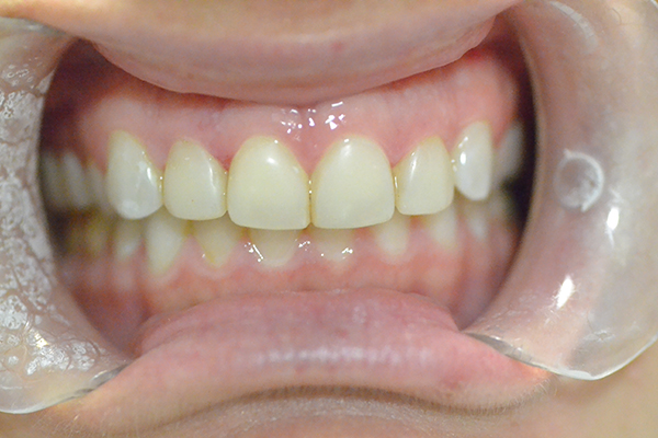 Gramercy Smiles | Dentures, Veneers and Root Canals