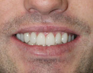 Gramercy Smiles | Sleep Apnea, CBCT and Dental Bridges