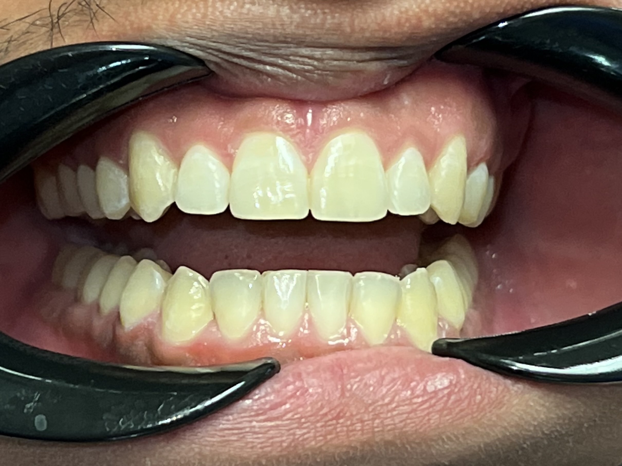 Gramercy Smiles | Sleep Apnea, Crowns & Caps and Dentures