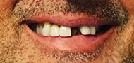 Gramercy Smiles | Extractions, Invisalign reg  and Dentures