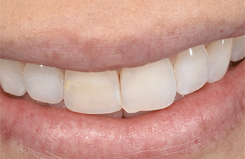 Gramercy Smiles | Root Canals, Dental Fillings and Dental Bridges