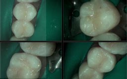 Gramercy Smiles | Dentures, CBCT and ZOOM! Whitening