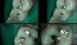 Gramercy Smiles | Crowns & Caps, Dental Fillings and Dental Cleanings