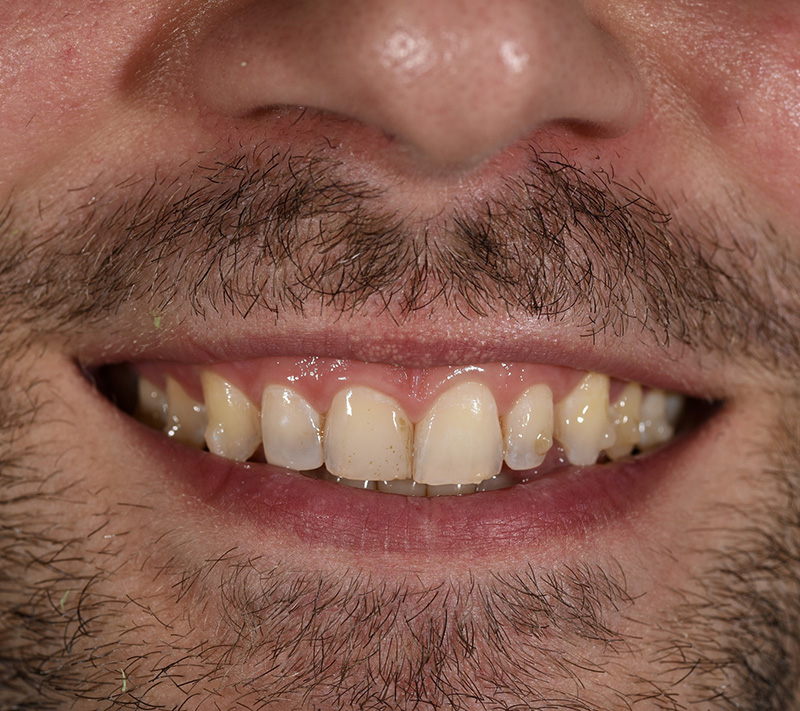 Gramercy Smiles | Prosthodontics, Dental Fillings and Dentures