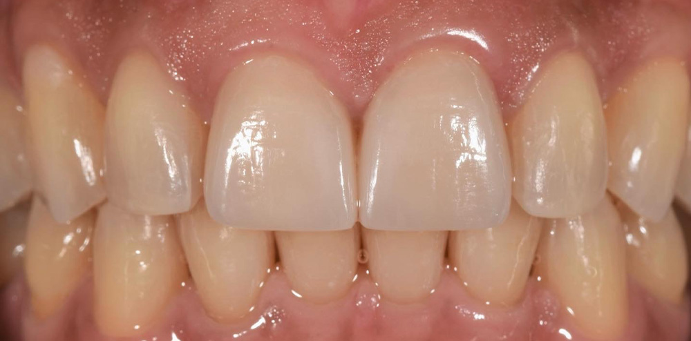 Gramercy Smiles | Prosthodontics, Zeiss reg  Microscope and Root Canals