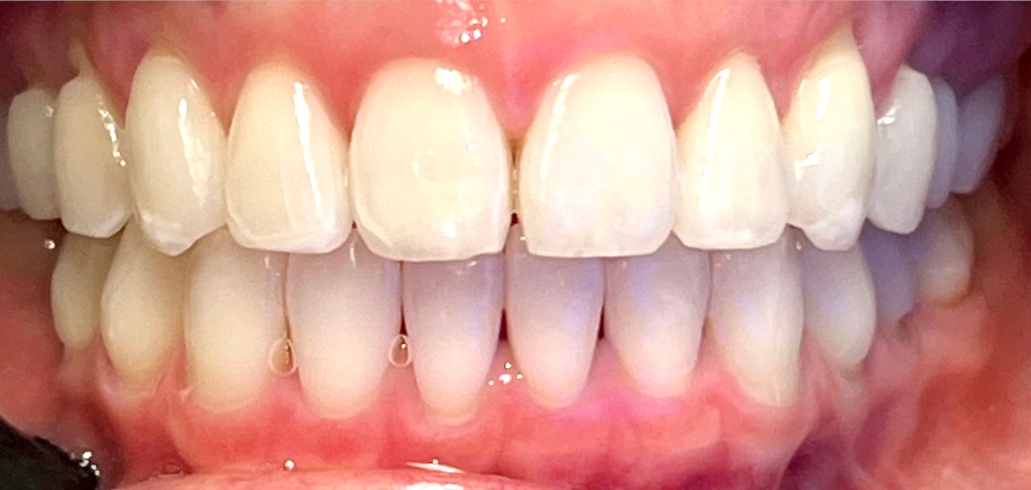 Gramercy Smiles | Dental Fillings, Dentures and Oral Exams