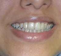 Gramercy Smiles | Oral Exams, Dental Bridges and Dentures