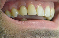 Gramercy Smiles | Implant Restorations, Invisalign® and Preventative Program