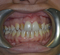 Gramercy Smiles | CBCT, Root Canals and Dentures