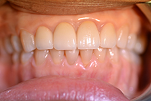 Gramercy Smiles | Extractions, Prosthodontics and ZOOM  Whitening
