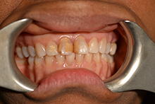 Gramercy Smiles | Veneers, Dental Cleanings and Oral Surgery