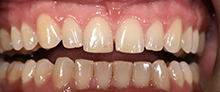 Gramercy Smiles | Crowns & Caps, Oral Surgery and Laser Dentistry