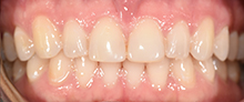 Gramercy Smiles | Invisalign®, Dental Cleanings and Cosmetic Dentistry